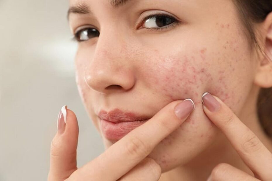 Manage Acne and Reduce Pimples
